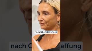 oberlidstraffung lidkorrektur lid straffung antiage düsseldorf plastischechirurgie [upl. by Nylirej]