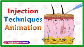 Injection Techniques Animation  Intradermal Intramuscular Subcutaneous and Z track [upl. by Yendic50]