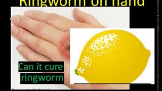 how to use lemon for ringworm ringworm home remedy [upl. by Clementia]