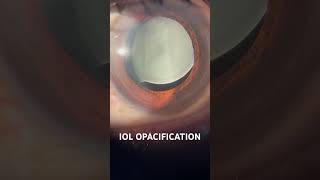 IOL Opacification ophthalmology eyehospital eyehospitalvaranasi [upl. by Wachter]