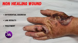 Non healing hand wound  How to heal [upl. by Porte]