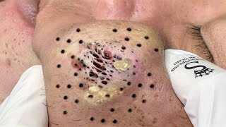 Blackhead Removal With Sac Dep Spa 1000339 [upl. by Autumn]