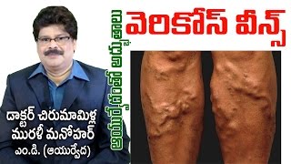 Varicose Veins  Ayurvedic Treatment  వేరికోస్ వీన్స్  Dr Murali Manohar Chirumamilla MD Ay [upl. by Arbed]