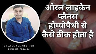 मुंह के लाइकेन प्लेनस का होम्योपैथी से इलाज  मरीज़ की जुबानी  Lichen planus homeopathic treatment [upl. by Niuqaoj]