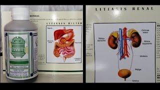 Litiasis Biliar Renal y de Vejiga Solución [upl. by Harleigh]