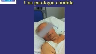 Diagnosi e trattamento Idrocefalo Normoteso  caso clinico [upl. by Oiraved]