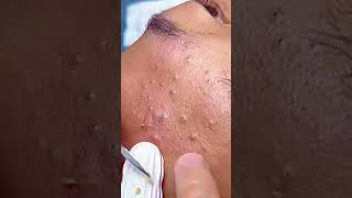 Huge Blackhead Extraction Extremely Satisfying [upl. by Porter44]