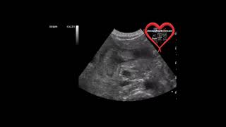 Pyloric Stenosis Ultrasound [upl. by Saberhagen]