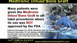 Medtronic Infuse Bone Graft Lawsuits [upl. by Akital868]