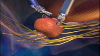 Robot Da Vinci Prostatectomia  Urologia Savona  wwwurologiasavonait [upl. by Lednic418]