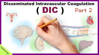 DIC Disseminated Intravascular Coagulation  Part 2 [upl. by Marba162]