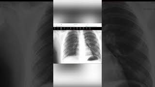 Diagnosis of Peritonitis due to perforated peptic ulcer with upright CHEST X RAY  CXR  cxr [upl. by Atinit]