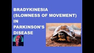 Vlog 156 Bradykinesia In Parkinsons Disease [upl. by Aenej956]