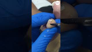 Tip of toe callus debridement [upl. by Oremo769]