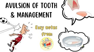 AVULSION  TRAUMATIC INJURIES OF TOOTH  MANAGEMENT endodontics [upl. by Euphemia37]