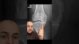 Arthrose du genou  à quoi ça ressemble [upl. by Yaron]