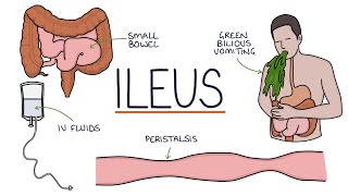 Understanding Ileus Paralytic Ileus [upl. by Damalas]