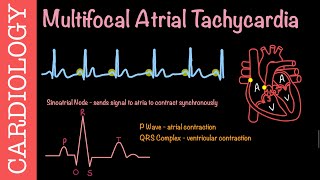 Multifocal Atrial Tachycardia  Cardiovascular Pathophysiology [upl. by Neenwahs856]