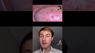 Reacting to Magnifying Pore Vacuum Removing Blackhead shorts [upl. by Slaughter]