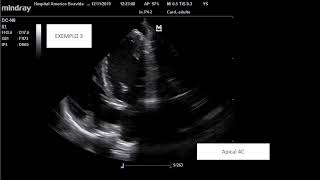 Endocardite Infecciosa  Infective Endocarditis  vegetations on echocardiography [upl. by Nnaitsirhc764]