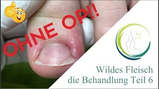 Wildes Fleisch die Behandlung Teil 6 podologinandrea [upl. by Gradeigh472]