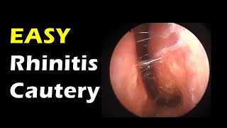 Very Easy Rhinitis treatment simple cautery [upl. by Mayor]