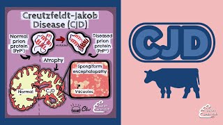 Creutzfeldt Jakob Disease CJD [upl. by Slade]