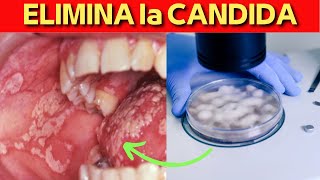 TRATAMIENTO NATURAL para ELIMINAR la CANDIDA [upl. by Airebma810]