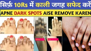 Dark Spots Removal At Home  How To Remove Dark Spots  Dr Saad Ahmed [upl. by Naves]