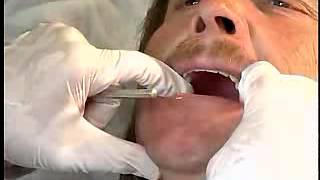 Complete Denture Procedure  20 INITIAL PLACEMENT OF THE DENTURES [upl. by Arelc507]