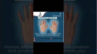 Psoriatic arthritis treatment [upl. by Ennirroc807]