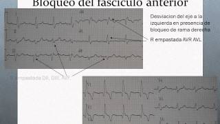 Bloqueo trifascicular e infarto anteroseptalwmv [upl. by Allebara]