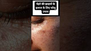 चेहरे की झाइयों के लिए घरेलू उपाय। HOW TO CURE PIGMENTATION AT HOME I DR MANOJ DAS [upl. by Saenihp327]