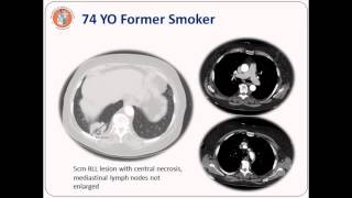 Mediastinal Staging Webinar [upl. by Pettifer]