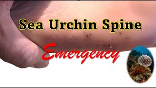 Sea Urchin Spine Emergency in the Dominican Republic [upl. by Mariande]