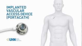 PortaCath Implanted Vascular Access Device [upl. by Codie163]