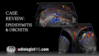 Ultrasound of Epididymitis amp Orchitis [upl. by Keheley]