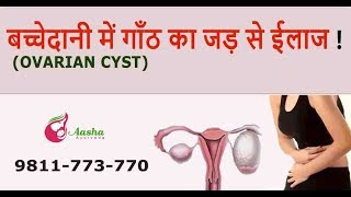 Ovarian Cyst Treatment Without Surgery  Aasha Ayurveda [upl. by Watkin866]