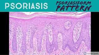 Psoriasis amp Psoriasiform Dermatitis Pattern  Inflammatory Dermpath Basics for Dermatology Pathology [upl. by Waverly]