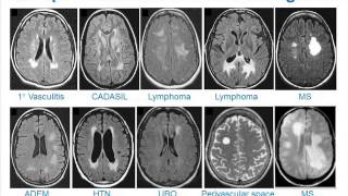 MRI Uses in MS [upl. by Celia]