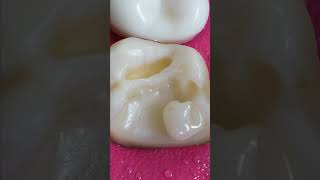 INCREDIBLE Tooth Filling toothcavity shorts [upl. by Clere700]