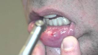 Fotona Laser Mucocele removal Boynton Laser Dental [upl. by Enihpets]