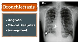 Bronchiectasis  Clinical features amp Management [upl. by Nivan59]