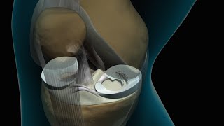 Torn Knee Meniscus Repair [upl. by Bej]