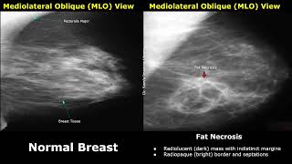 Mammography Normal Vs Abnormal Images  BIRADS Classification  Breast Cancer amp Other Diseases [upl. by Chuck932]