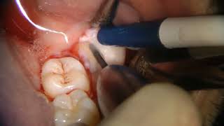 Extração de terceiro molar inferior incluso” [upl. by Sherwynd]