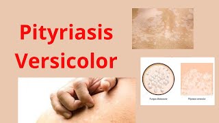 Comment guérir le Mycose cutanée Pityriasis versicolor [upl. by Enecnarf]