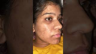 Tretinoin cream 0025 transformation No acne No dark spot acne skincare tretinoin darkspots [upl. by Farhsa886]