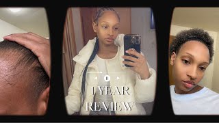 1 YEAR HAIR TRANSPLANT REVIEW GOT MY HAIR BRAIDED FIRST TIME IN YEARS WILL I GO BACK TO LONGEVITA [upl. by Fendig]