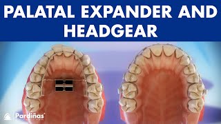 Orthodontic devices  Palatal expander and headgear © [upl. by Aerdma]